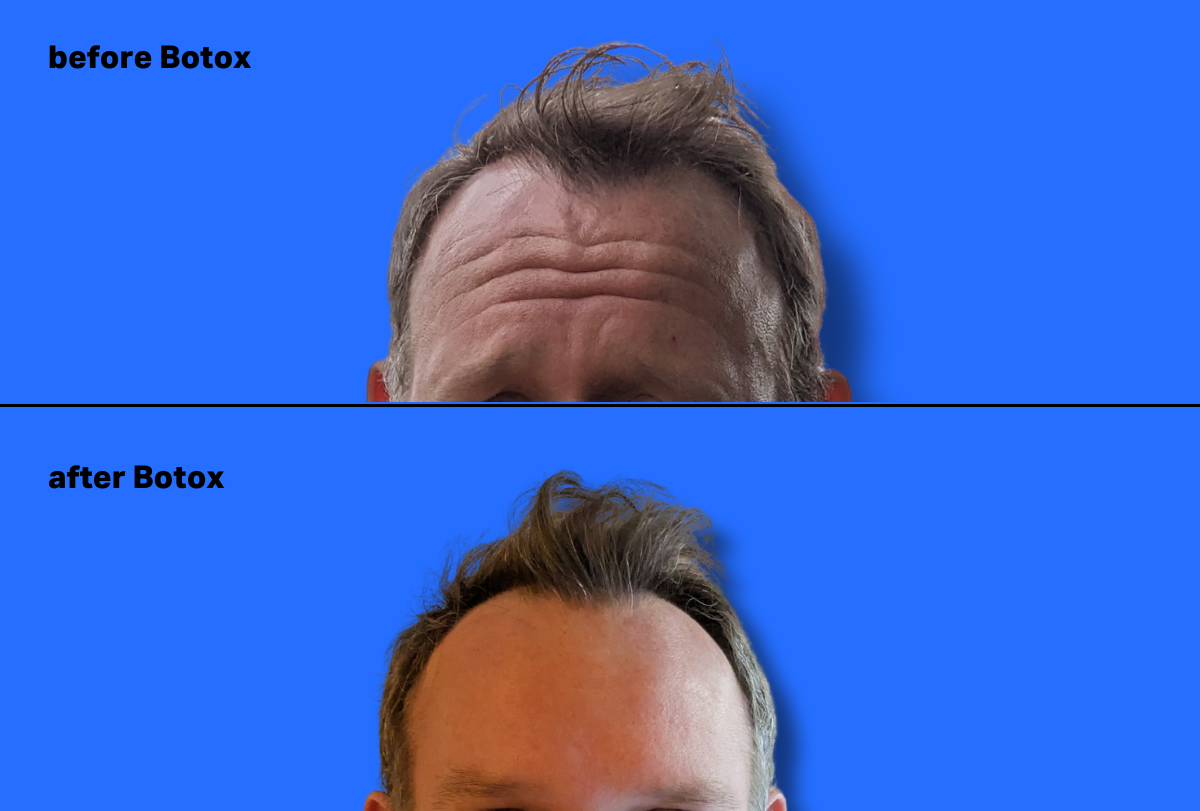 botox for men before and after