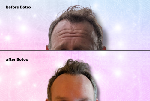 forehead botox for men